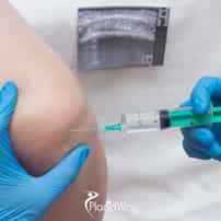 Affordable Stem Cell Cartilage Therapy in Mexico for Canadians
